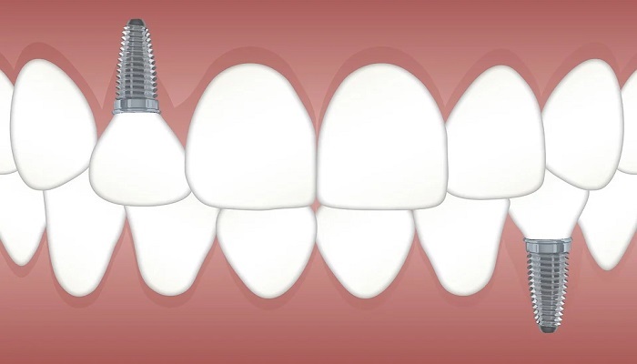 Colocación de implantes dentales, la mejor opción para una mejor sonrisa